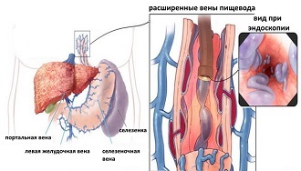Варикозное расширение вен в желудке