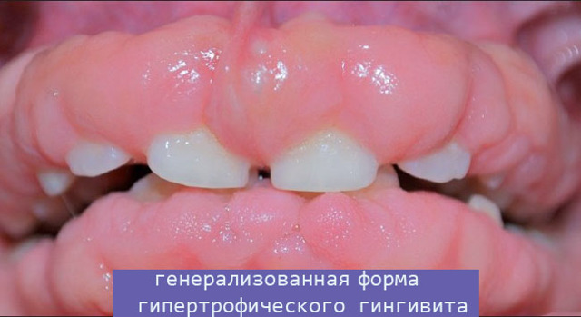 Гипертрофический гингивит