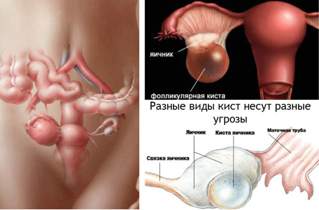 Фолликулярная киста яичника - симптомы, лечение, причины