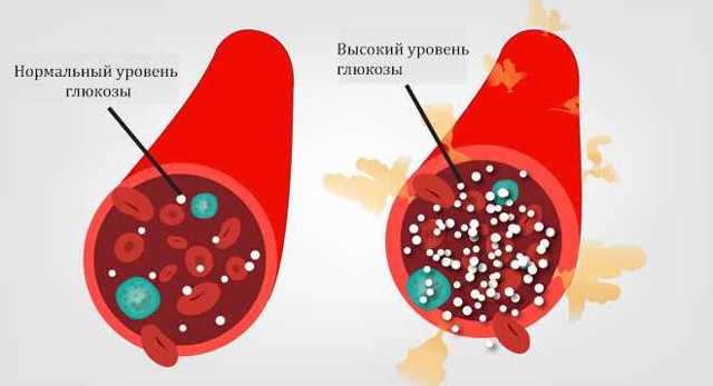 Повышена глюкоза в крови что это значит