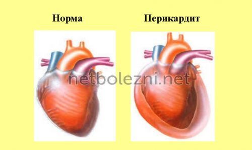 Болит и колит сердце при вдохе: причины, что делать?