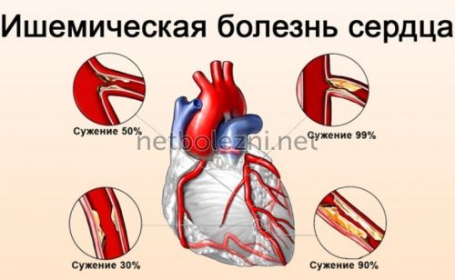 Стентирование коронарных артерий: операция, послеоперационный период, реабилитация