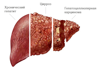 Что такое АЛТ в биохимическом анализе крови