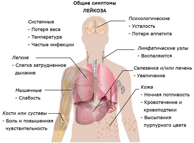 Лейкоз – причины и симптомы лейкоза