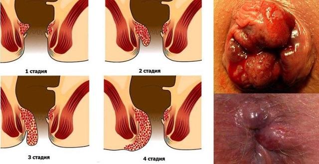 Мазь Левомеколь при геморрое - инструкция