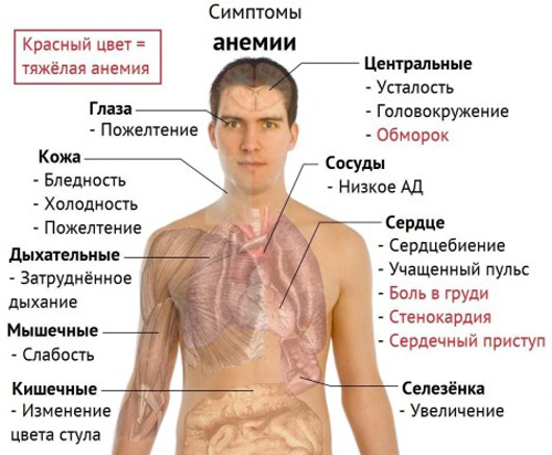 Анемия – что это такое? Симптомы и лечение