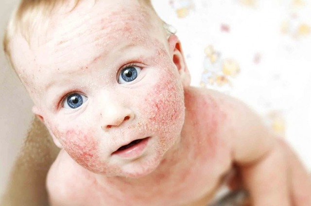 Нейродермит у взрослых и детей: симптомы (фото), лечение