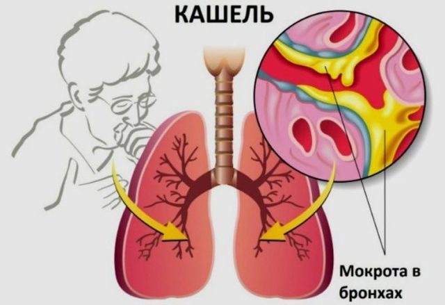 Мокрота белого цвета при кашле