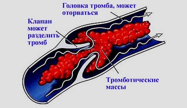 Тромбоэмболия - что это такое: признаки, диагностика и профилактика
