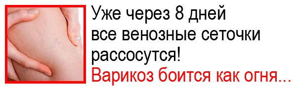 Начинается варикоз на ногах что делать на сайте варикоз
