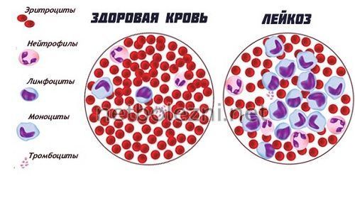 Почему в крови мало тромбоцитов: причины снижения и что с этим делать