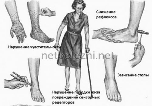 Мазь при полинейропатии нижних конечностей: классификация, медикаменты, народные средства, проявления