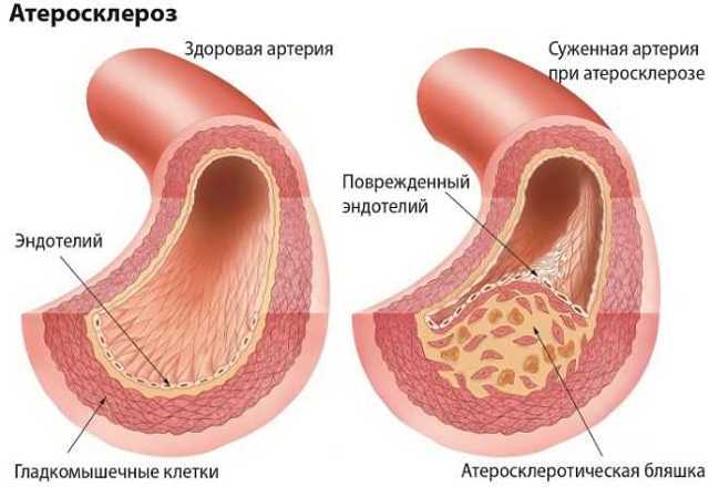 Гипертония 2 степени риск 2