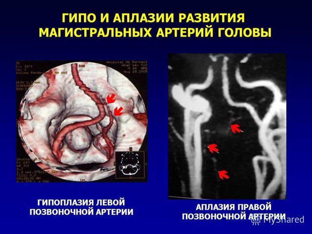 Почему появляется гипоплазия головного мозга