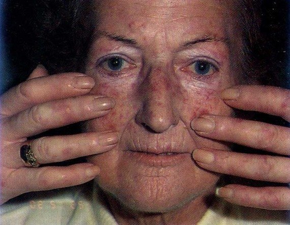 Системная склеродермия - диагностика, лечение, прогноз