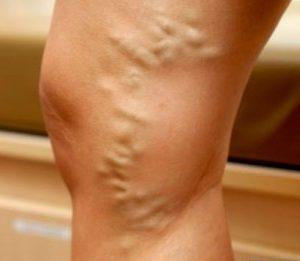 Тромб в ноге – причины, симптомы и лечение