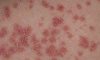 Лечение псориаз на руках - фото, симптомы, виды псориаза на руках