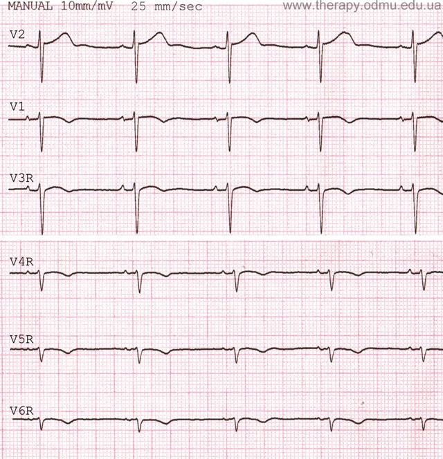 Стандартные отведения от конечностей - 1,2,3