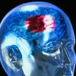 Ишемический инсульт - причины, симптомы, диагностика и лечение