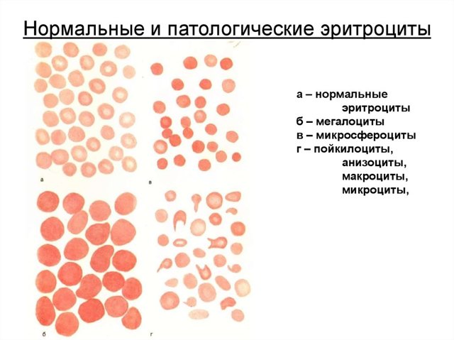 Микроцитоз в анализе крови у взрослых и детей: что это такое, причины и лечение