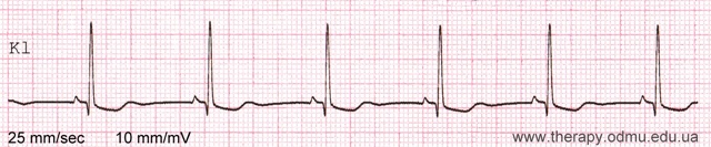 Стандартные отведения от конечностей - 1,2,3