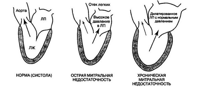 Недостаточность митрального клапана - симптомы болезни, профилактика и лечение Недостаточности митрального клапана, причины заболевания и его диагностика на EUROLAB