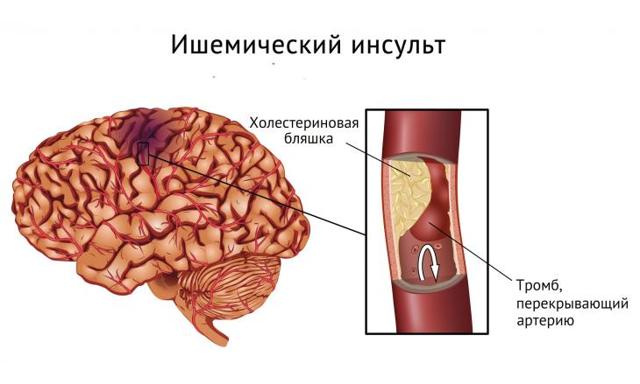 Верхнее давление высокое нижнее в норме