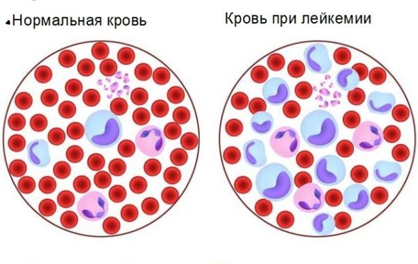 Лейкоз — Википедия (с комментариями)