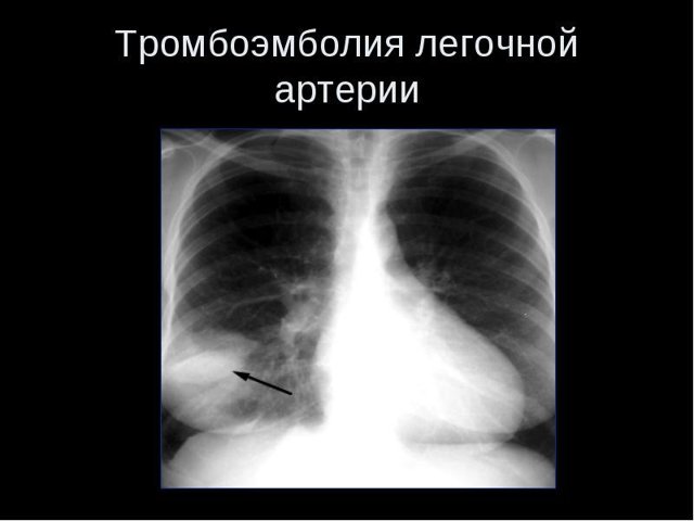 Тромбоэмболия - что это такое: признаки, диагностика и профилактика