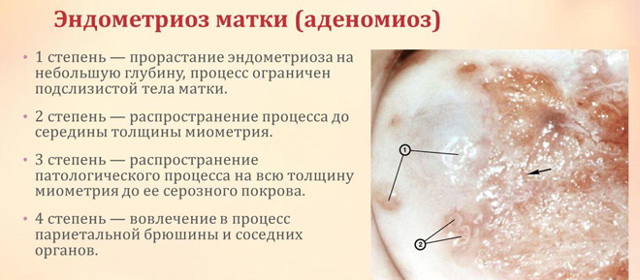 Визанна - инструкция по применению при эндометриозе, отзывы и сколько стоит?