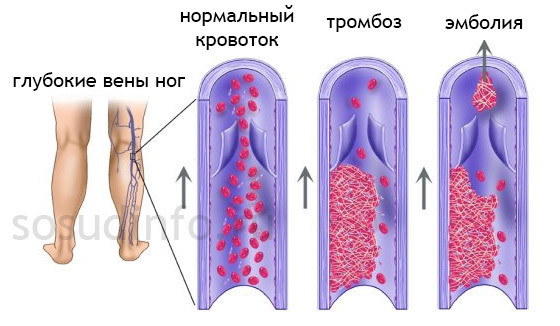 Симтомы, диагностика и лечение закупорки кровеносных сосудов