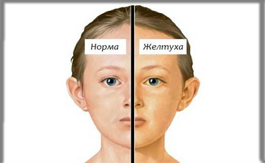 Что это значит - у взрослого повышен общий билирубин