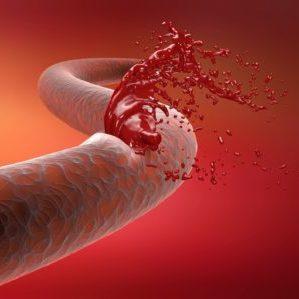 Тромбоцитопения: причины и лечение у взрослых