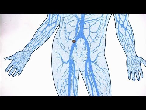 Тромбофлебит легких лечение