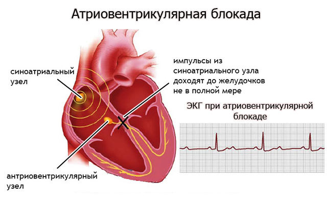 Виды аритмии сердца — типы, разновидности и их главные особенности