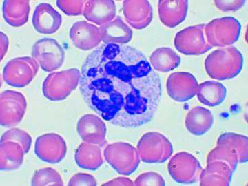 Если палочкоядерные нейтрофилы 0 у взрослого – о чем это говорит. Почему у ребенка повышены сегментоядерные и палочкоядерные нейтрофилы: причины высоких показателей в анализе крови