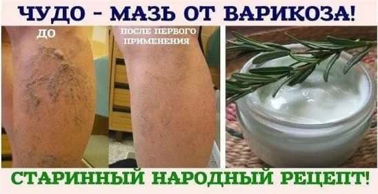 Народные средства от варикоза