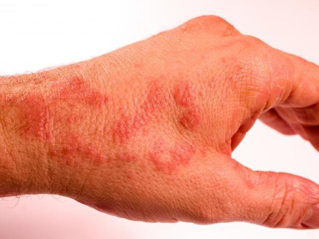 Ацербин спрей: инструкция по применению, показания, цена, отзывы врачей, аналоги спрея Ацербин