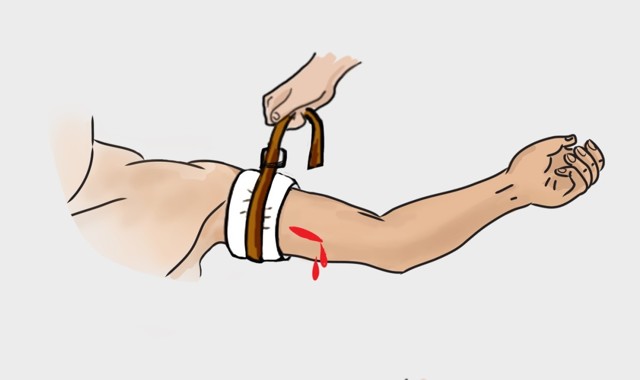 Виды кровотечений и оказание первой помощи