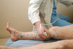 Что такое эндартериит - симптомы и лечение