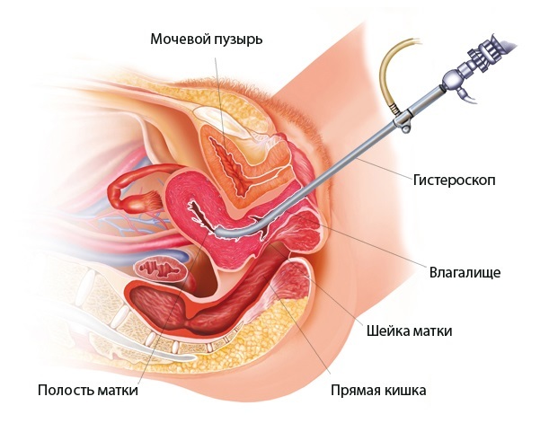 Когда начинаются месячные после выскабливания и сколько идут?