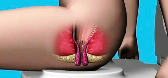 Индометацин свечи при геморрое - инструкция и отзывы