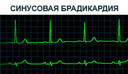 Брадикардия – симптомы, лечение, причины, брадикардия у детей