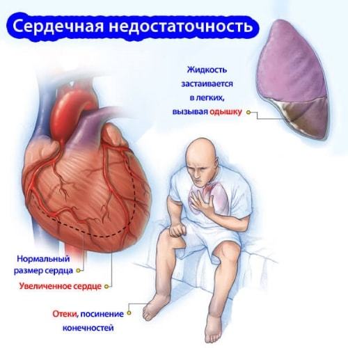 Кашель при сердечной недостаточности - Гипертонии нет