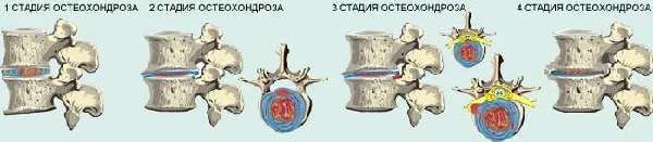Нарушение мозгового кровообращения при шейном остеохондрозе