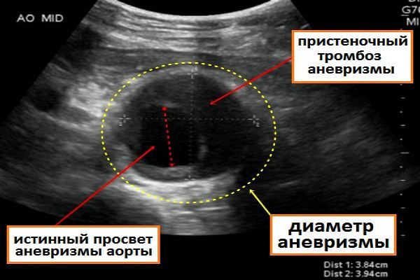 УЗИ сосудов (артерий и вен) нижних конечностей – показания и основы процедуры
