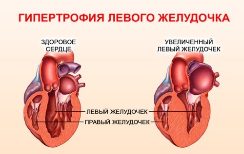 Амлодипин или энап что лучше - Все про гипертонию