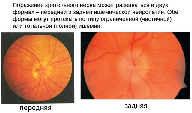 Ишемические заболевания сетчатки глаза и зрительного нерва