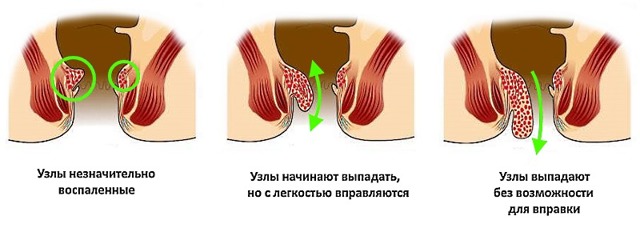 Йога при геморрое, йога против геморроя – упражнения