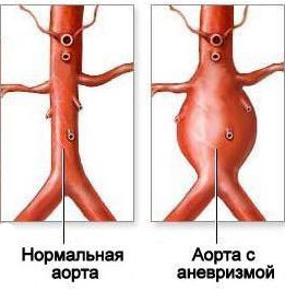 Дилатация камер сердца что это такое - Все про гипертонию